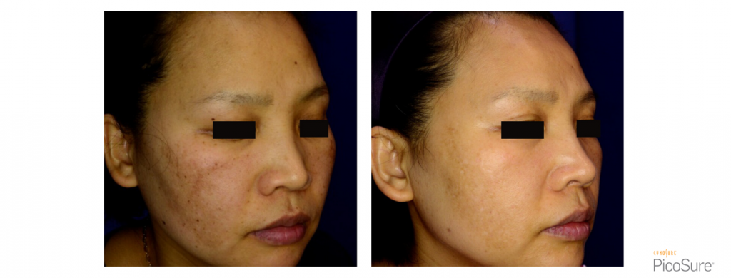PicoSure Hyperpigmentation Side of face 1