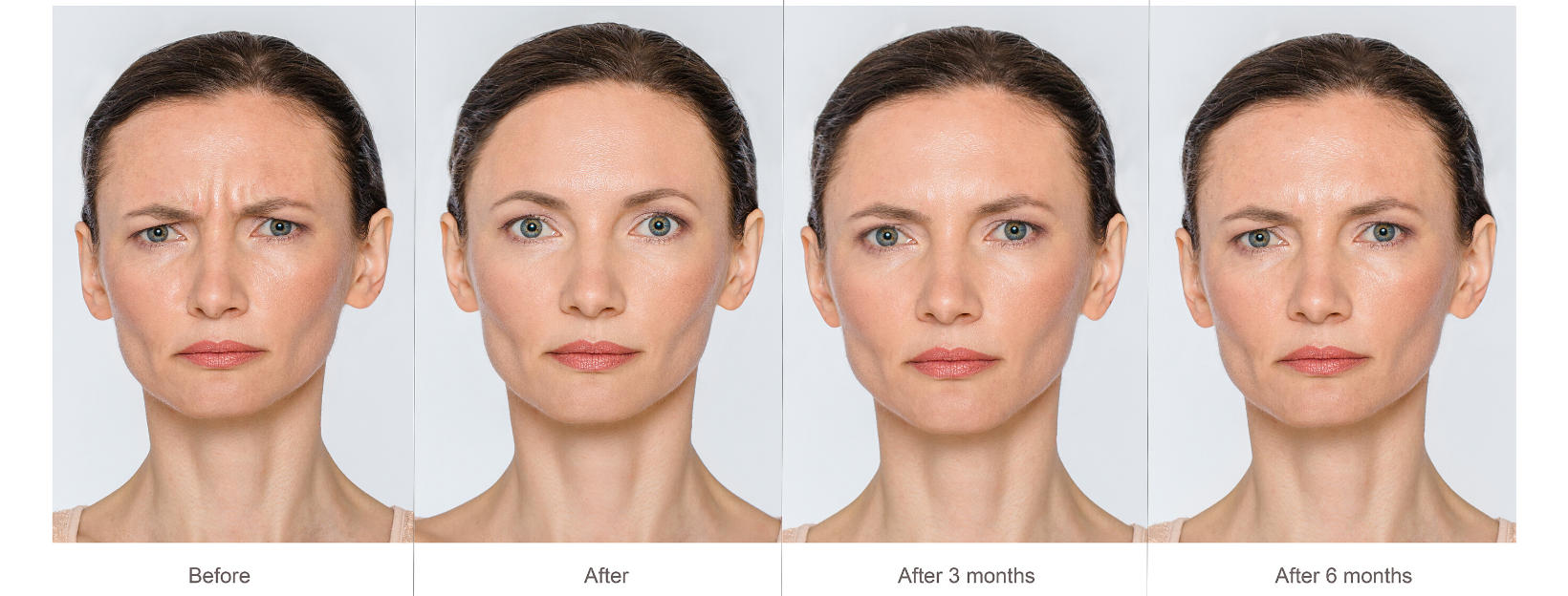 Anti-Wrinkle Injections Before, During, After
