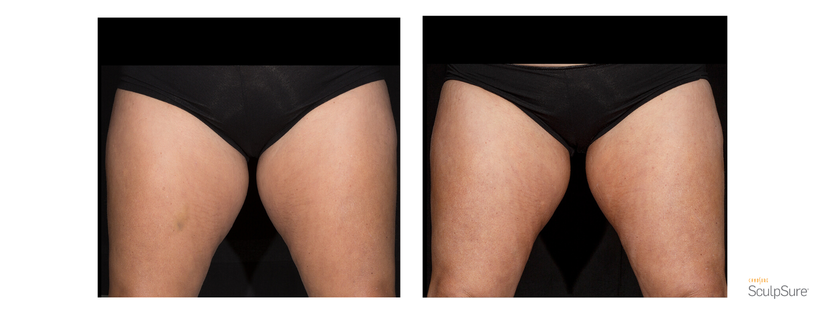 SculpSure Inner Thighs